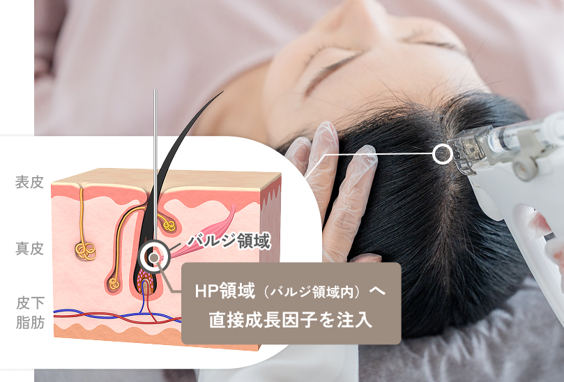 HP領域（バルジ領域内）へ直接成長因子を注入